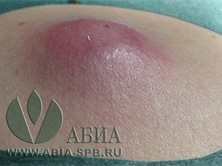 Нагноившаяся атерома спины. Подготовка к удалению.