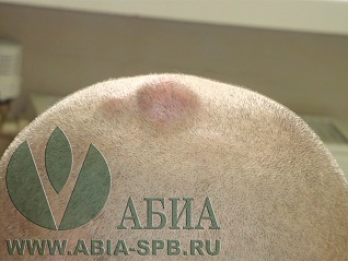 Две атеромы головы.