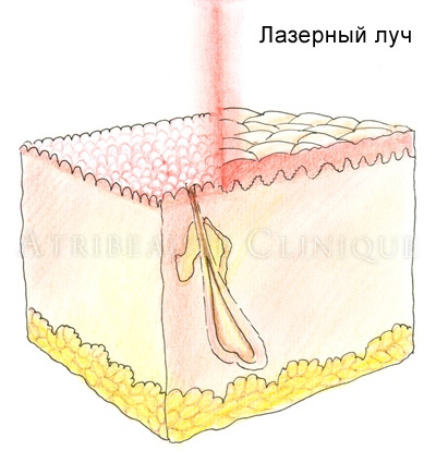 Удаление шрамов лазером