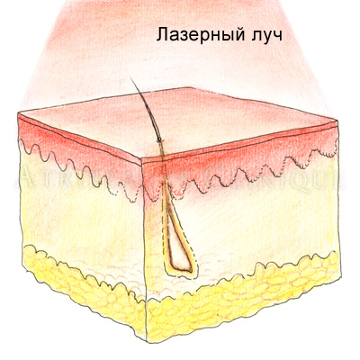 Лазер для удаления шрамов